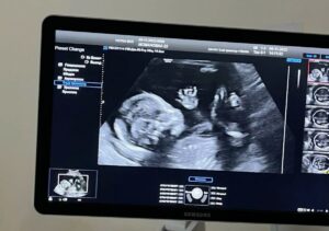 سونوگرافی ان تی