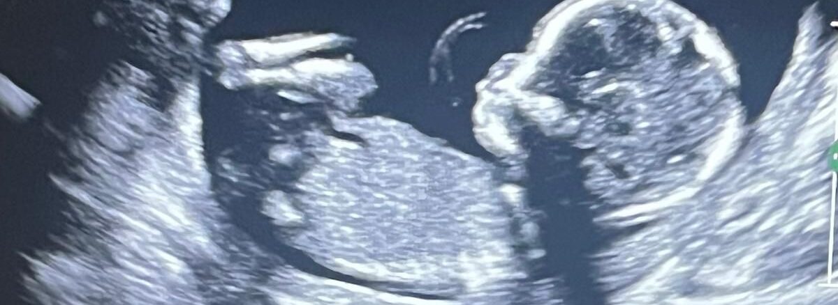 سونوگرافی ان تی