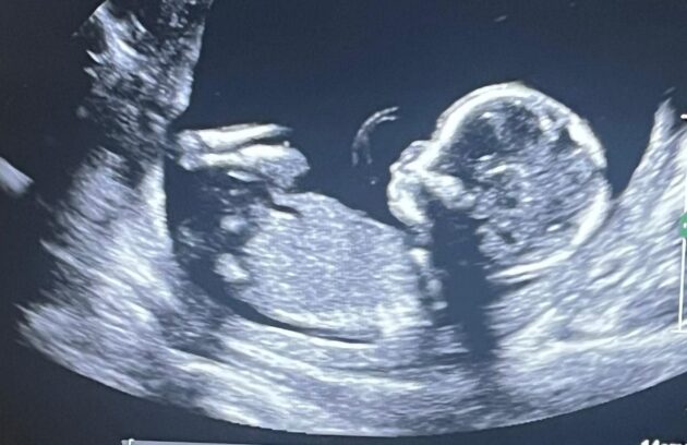 سونوگرافی ان تی