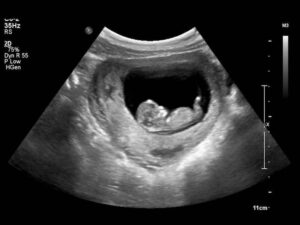 سونوگرافی ان تی